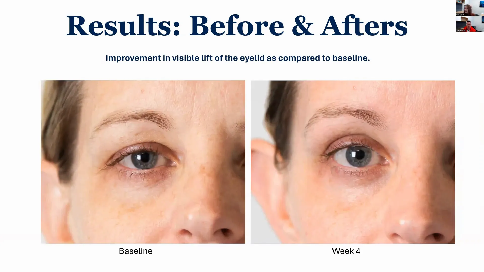 Avant Après Résultats Truescience Activated Skin Care Collection | Nutrigenomics Store 4 Avant et après le lifting des yeux et la réduction des poches